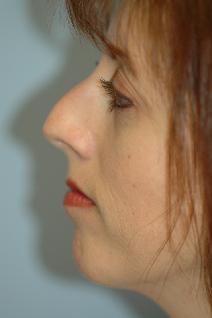 Rhinoplasty Before Photo by Lucie Capek, MD; Latham, NY - Case 8836