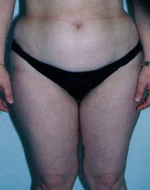 Liposuction Before Photo by Lucie Capek, MD; Cohoes, NY - Case 8855