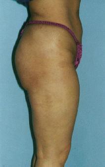 Liposuction After Photo by Lucie Capek, MD; Cohoes, NY - Case 8855