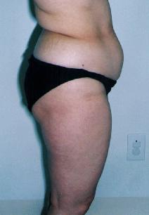 Liposuction Before Photo by Lucie Capek, MD; Cohoes, NY - Case 8855