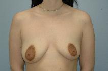 Breast Lift Before Photo by Lucie Capek, MD; Cohoes, NY - Case 8856