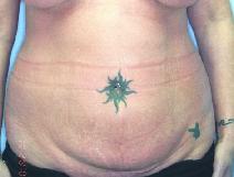 Tummy Tuck Before Photo by Lucie Capek, MD; Cohoes, NY - Case 8862