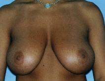 Breast Reduction Before Photo by Lucie Capek, MD; Cohoes, NY - Case 8865