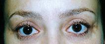 Eyelid Surgery After Photo by Lucie Capek, MD; Cohoes, NY - Case 9240