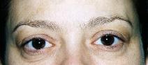Eyelid Surgery Before Photo by Lucie Capek, MD; Cohoes, NY - Case 9240