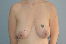 Breast Lift Before Photo by Lucie Capek, MD; Latham, NY - Case 9422
