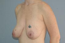 Breast Lift Before Photo by Lucie Capek, MD; Cohoes, NY - Case 9422