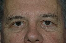 Eyelid Surgery Before Photo by Lucie Capek, MD; Cohoes, NY - Case 9423