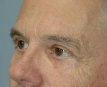 Eyelid Surgery After Photo by Lucie Capek, MD; Cohoes, NY - Case 9423
