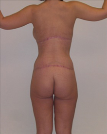 Body Contouring After Photo by Carmen Kavali, MD; Atlanta, GA - Case 25191