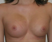 Breast Augmentation After Photo by Carmen Kavali, MD; Atlanta, GA - Case 25351