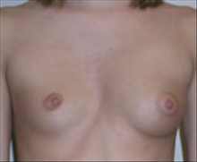 Breast Augmentation Before Photo by Carmen Kavali, MD; Atlanta, GA - Case 25351