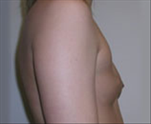 Breast Augmentation Before Photo by Carmen Kavali, MD; Atlanta, GA - Case 25351