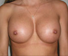 Breast Augmentation After Photo by Carmen Kavali, MD; Atlanta, GA - Case 25353