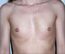 Breast Augmentation Before Photo by Carmen Kavali, MD; Atlanta, GA - Case 25353