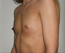 Breast Augmentation Before Photo by Carmen Kavali, MD; Atlanta, GA - Case 25353