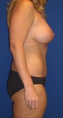 Breast Lift After Photo by Carmen Kavali, MD; Atlanta, GA - Case 25354