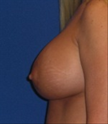 Breast Lift After Photo by Carmen Kavali, MD; Atlanta, GA - Case 25357