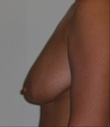 Breast Lift Before Photo by Carmen Kavali, MD; Atlanta, GA - Case 25357