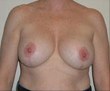 Breast Lift After Photo by Carmen Kavali, MD; Atlanta, GA - Case 25359