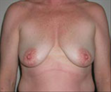 Breast Lift Before Photo by Carmen Kavali, MD; Atlanta, GA - Case 25359