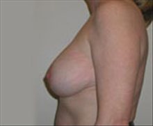 Breast Lift After Photo by Carmen Kavali, MD; Atlanta, GA - Case 25359