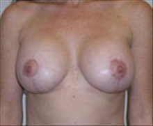 Breast Lift After Photo by Carmen Kavali, MD; Atlanta, GA - Case 25360