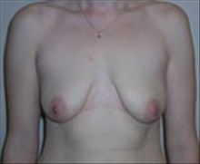 Breast Lift Before Photo by Carmen Kavali, MD; Atlanta, GA - Case 25360