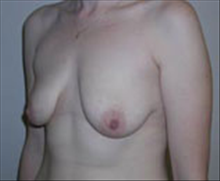 Breast Lift Before Photo by Carmen Kavali, MD; Atlanta, GA - Case 25360