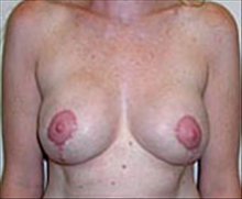 Breast Lift After Photo by Carmen Kavali, MD; Atlanta, GA - Case 25363