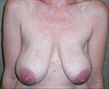 Breast Lift Before Photo by Carmen Kavali, MD; Atlanta, GA - Case 25363