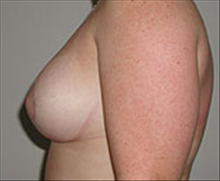 Breast Reduction After Photo by Carmen Kavali, MD; Atlanta, GA - Case 25364