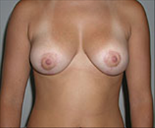 Breast Reduction After Photo by Carmen Kavali, MD; Atlanta, GA - Case 25365