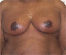 Breast Reduction After Photo by Carmen Kavali, MD; Atlanta, GA - Case 25367