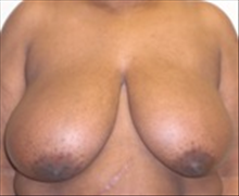 Breast Reduction Before Photo by Carmen Kavali, MD; Atlanta, GA - Case 25367