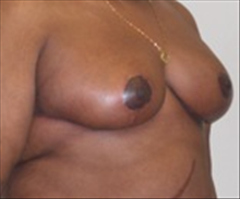 Breast Reduction After Photo by Carmen Kavali, MD; Atlanta, GA - Case 25367