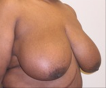 Breast Reduction Before Photo by Carmen Kavali, MD; Atlanta, GA - Case 25367