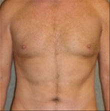 Male Breast Reduction After Photo by Carmen Kavali, MD; Atlanta, GA - Case 25369