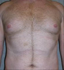 Male Breast Reduction Before Photo by Carmen Kavali, MD; Atlanta, GA - Case 25369