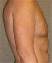 Male Breast Reduction After Photo by Carmen Kavali, MD; Atlanta, GA - Case 25369