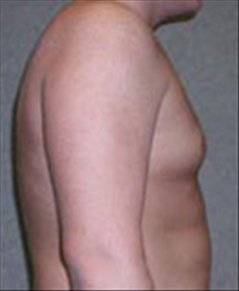 Male Breast Reduction Before Photo by Carmen Kavali, MD; Atlanta, GA - Case 25369