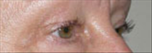 Eyelid Surgery Before Photo by Carmen Kavali, MD; Atlanta, GA - Case 25372