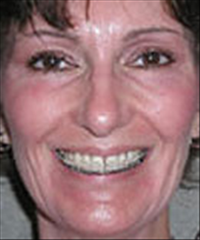 Eyelid Surgery After Photo by Carmen Kavali, MD; Atlanta, GA - Case 25374