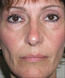 Eyelid Surgery Before Photo by Carmen Kavali, MD; Atlanta, GA - Case 25374