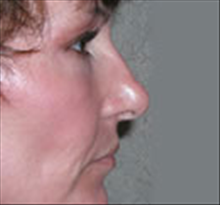 Eyelid Surgery After Photo by Carmen Kavali, MD; Atlanta, GA - Case 25374