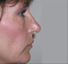 Eyelid Surgery Before Photo by Carmen Kavali, MD; Atlanta, GA - Case 25374