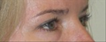 Eyelid Surgery After Photo by Carmen Kavali, MD; Atlanta, GA - Case 25375
