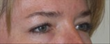 Eyelid Surgery Before Photo by Carmen Kavali, MD; Atlanta, GA - Case 25375