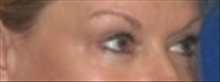 Eyelid Surgery After Photo by Carmen Kavali, MD; Atlanta, GA - Case 25376