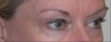 Eyelid Surgery Before Photo by Carmen Kavali, MD; Atlanta, GA - Case 25376